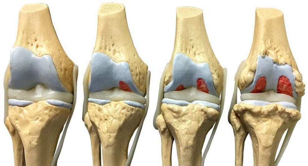 Etapas de desarrollo de la artrosis de la articulación de la rodilla. 