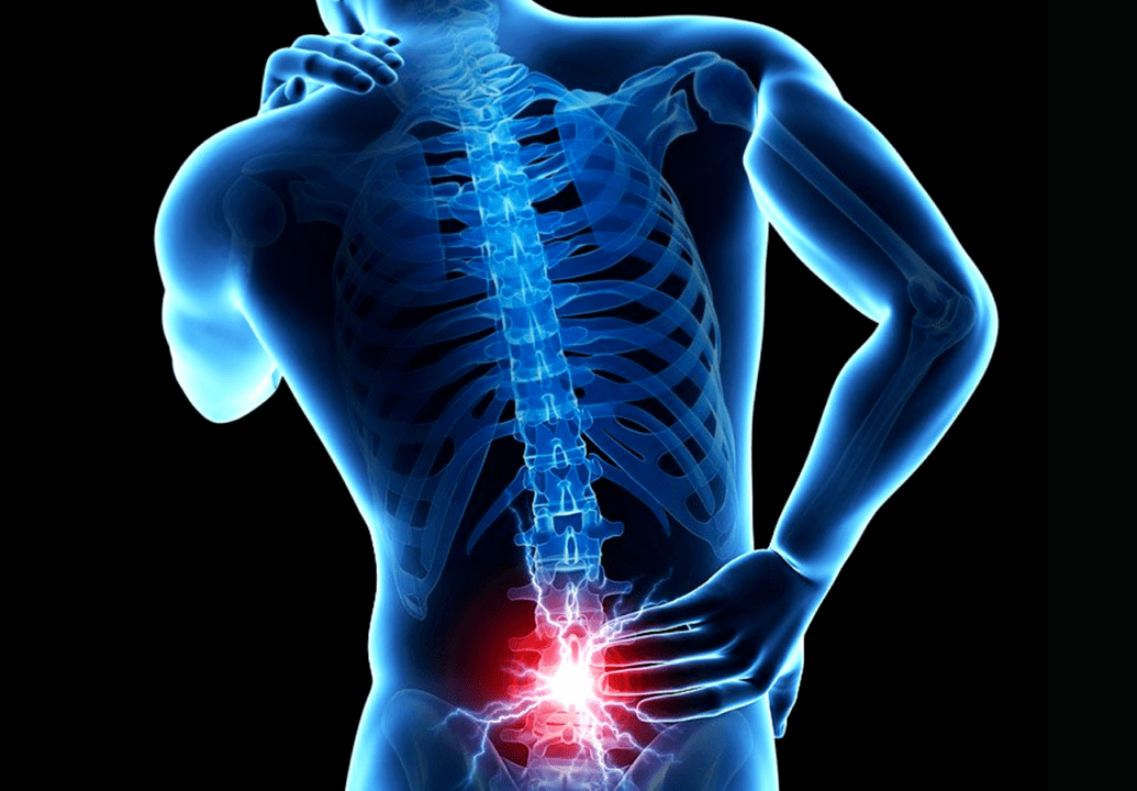 signos de osteocondrosis lumbar