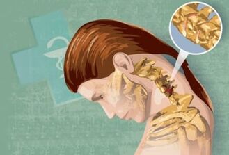 Síntomas reflejos de la osteocondrosis cervical