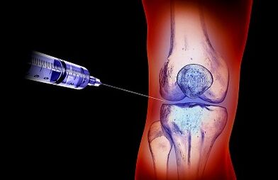 El plan de tratamiento para la artrosis de la articulación de la rodilla