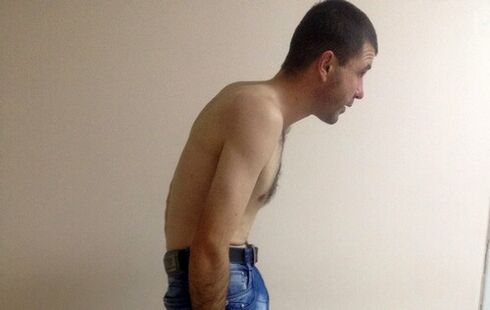 La espondilitis anquilosante puede provocar dolor lumbar con el paso de los años