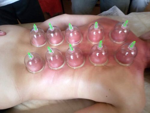 Las ventosas son una excelente manera de tratar el dolor lumbar en casa