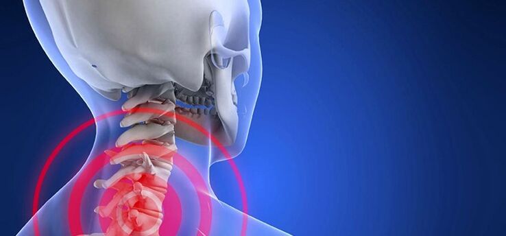 Osteocondrosis de la columna cervical.