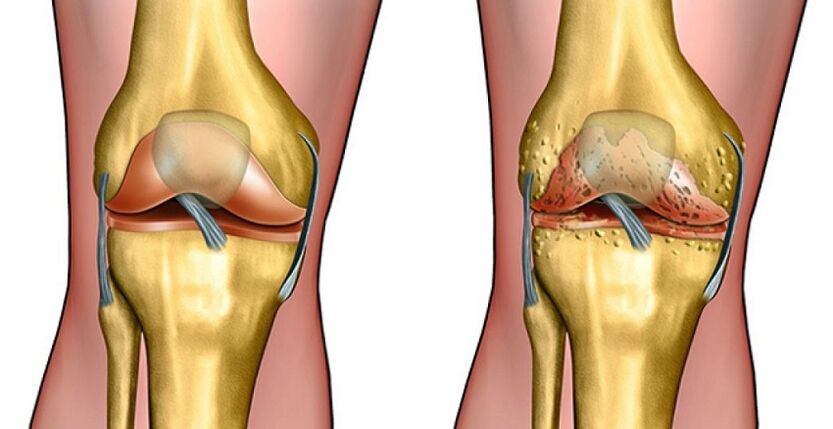 articulación sana y artrosis de la articulación de la rodilla